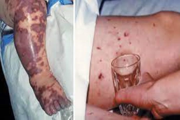 Aussie State Issued Alert For Meningococcal Disease