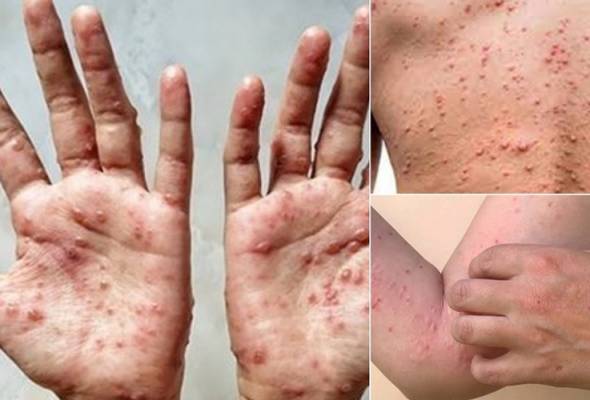 Nine cases of monkeypox reported in Malaysia